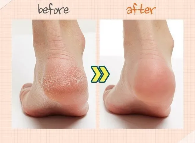 A'pieu Soft Foot 30 Minute Peeling Socks - rūgštinis pėdų šveitiklis · 3